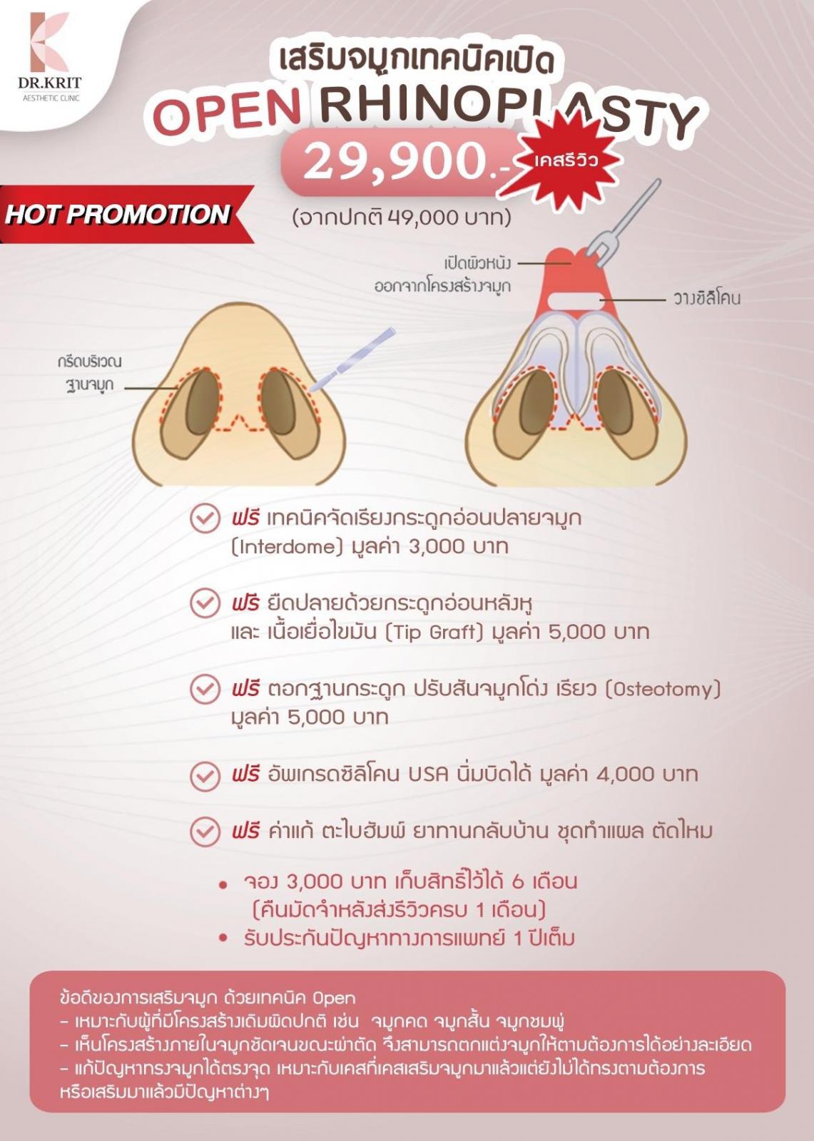 เสริมจมูก เทคนิคเปิด แบบโอเพ่น Open Rhinoplasty เชียงใหม่