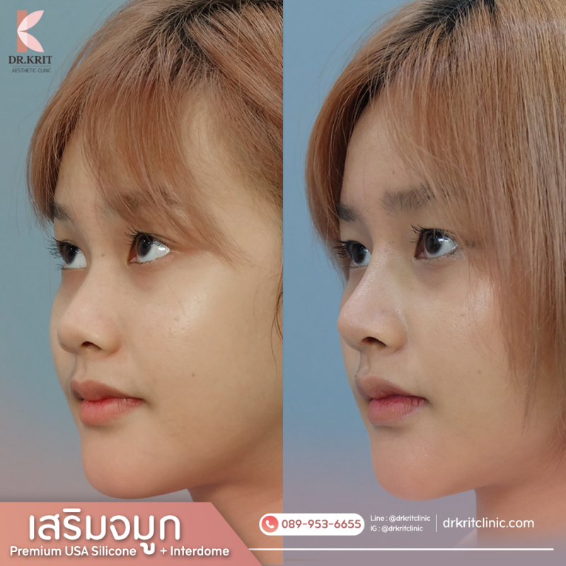 เสริมจมูก