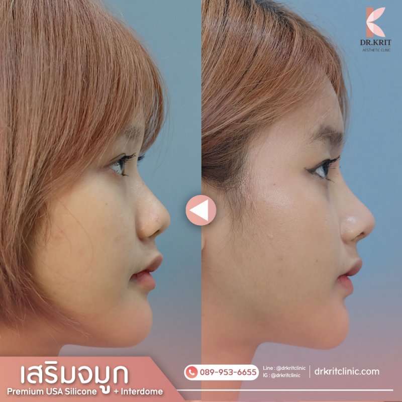 เสริมจมูก