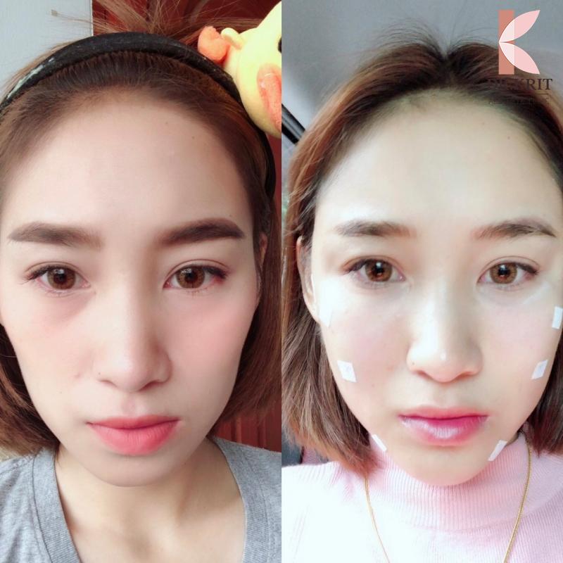 เติมไขมันหน้าเด็ก