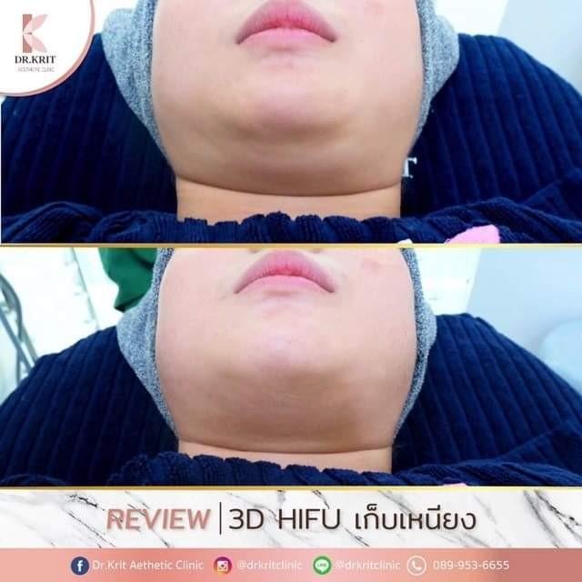 hifu ไฮฟู ยกกระชับใบหน้า เชียงใหม่